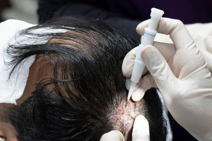 Haarausfall Nürnberg: Hautstraffung und Faltenbehandlung für einen frischen Teint
