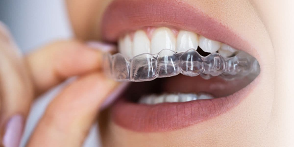Transformation des Teenagerlächelns: Transparente Aligner für Jugendliche