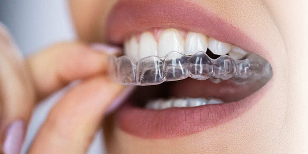 Transformation des Teenagerlächelns: Transparente Aligner für Jugendliche
