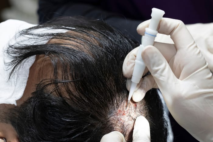 Haarausfall Nürnberg: Hautstraffung und Faltenbehandlung für einen frischen Teint